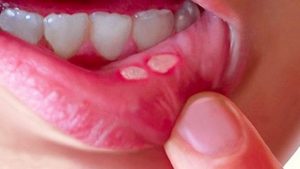 Viêm loét miệng khiến trẻ đau rát hoặc sốt