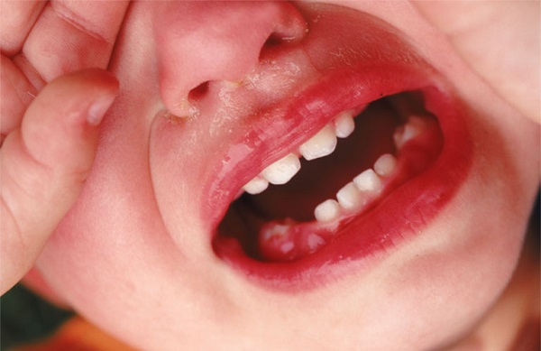 Virus bệnh tay chân miệng hoặc thủy đậu tấn công gây nên các vết viêm loét ở miệng